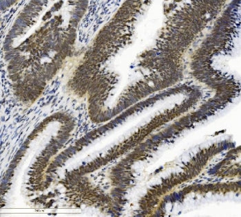 IHC staining of FFPE human low-differentiated adenocarcinoma with SMAD2 antibody. HIER: boil tissue sections in pH8 EDTA for 20 min and allow to cool before testing.