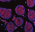 Immunofluorescent staining of NASP using anti-NASP antibody (red). NASP was detected in a paraffin-embedded section of human stomach cancer tissue. Heat mediated antigen retrieval was performed in EDTA buffer (pH 8.0, epitope retrieval solution). The tissue section was blocked with 10% goat serum. The tissue section was then incubated with 5 ug/ml rabbit anti-NASP antibody overnight at 4oC. Cy3 Conjugated Goat Anti-Rabbit IgG was used as secondary antibody at 1:500 dilution and incubated for 30 min at 37oC.
