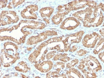 IHC staining of FFPE human prostate tissue with recombinant ODC1 antibody. HIER: boil tissue sections in pH6, 10mM citrate buffer, for 10-20 min and allow to cool before testing.