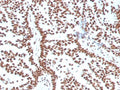 IHC staining of FFPE human breast carcinoma with Estrogen Receptor alpha antibody (clone ESR1/3556). HIER: boil tissue sections in pH 9 10mM Tris with 1mM EDTA for 10-20 min and allow to cool before testing.