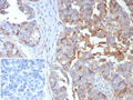 IHC staining of FFPE human ovarian cancer tissue with MX1 antibody (clone MX1/7529). Inset: PBS used in place of primary Ab (secondary Ab negative control). HIER: boil tissue sections in pH 9 10mM Tris with 1mM EDTA for 20 min and allow to cool before testing.