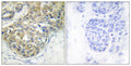 Immunohistochemistry analysis of paraffin-embedded human breast carcinoma, using ACK1 (Phospho-Tyr284) Antibody. The STJ91057