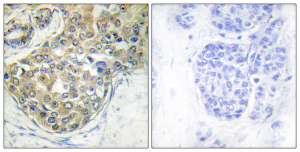 Immunohistochemistry analysis of paraffin-embedded human breast carcinoma, using ACK1 (Phospho-Tyr284) Antibody. The STJ91057