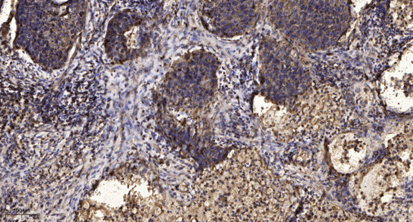Immunohistochemical analysis of paraffin-embedded human squamous cell carcinoma of lung. 1, Antibody was diluted at STJ94091