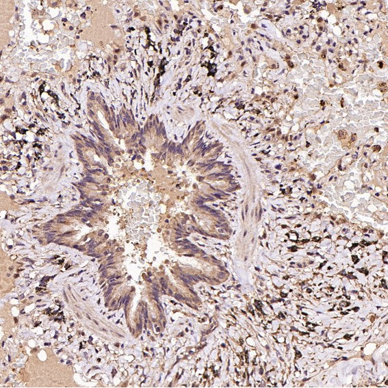 Immunohistochemical analysis of paraffin-embedded Human squamous carcinoma, using the Antibody at 1:100 dilution.