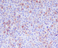 Immunohistochemical analysis of paraffin-embedded human T cell lymphoma, using Granzyme B Antibody.