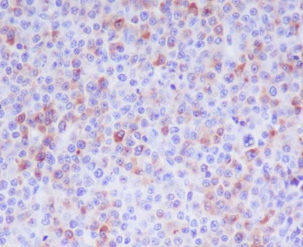 Immunohistochemical analysis of paraffin-embedded human T cell lymphoma, using Granzyme B Antibody.