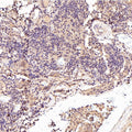 Immunohistochemical analysis of paraffin-embedded Human thyroid cancer, using the Antibody at 1:50 dilution.