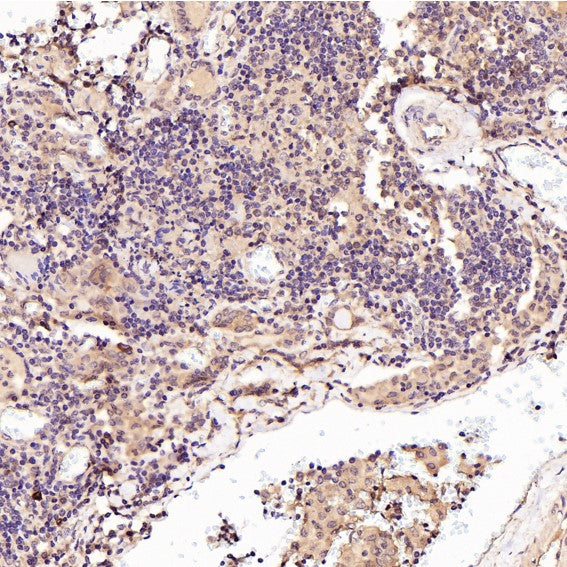 Immunohistochemical analysis of paraffin-embedded Human thyroid cancer, using the Antibody at 1:50 dilution.