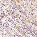 Immunohistochemical analysis of paraffin-embedded Human cervical cancer, using the Antibody at 1:100 dilution.