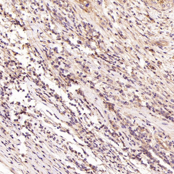 Immunohistochemical analysis of paraffin-embedded Human cervical cancer, using the Antibody at 1:100 dilution.
