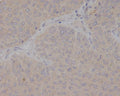 Immunohistochemical analysis of paraffin-embedded human bladder cancer, using GCET2 Antibody.