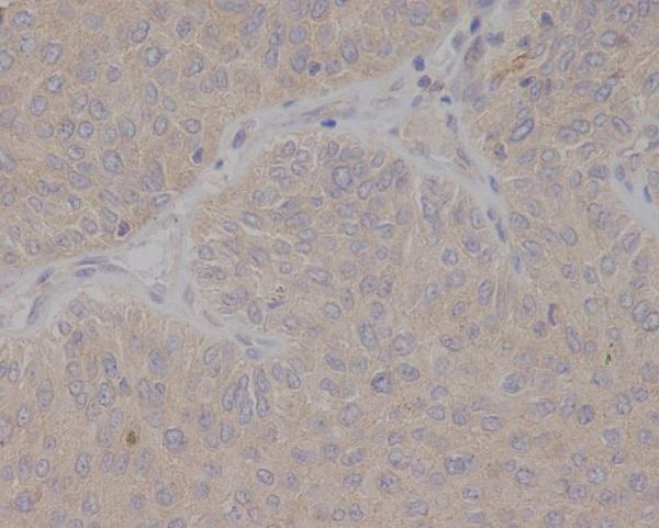 Immunohistochemical analysis of paraffin-embedded human bladder cancer, using GCET2 Antibody.
