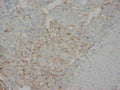 Anti-AFP antibody (monoclonal), MA1001, IHC(P)
IHC(P): Human Liver Cancer Tissue