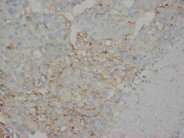 Anti-AFP antibody (monoclonal), MA1001, IHC(P)
IHC(P): Human Liver Cancer Tissue