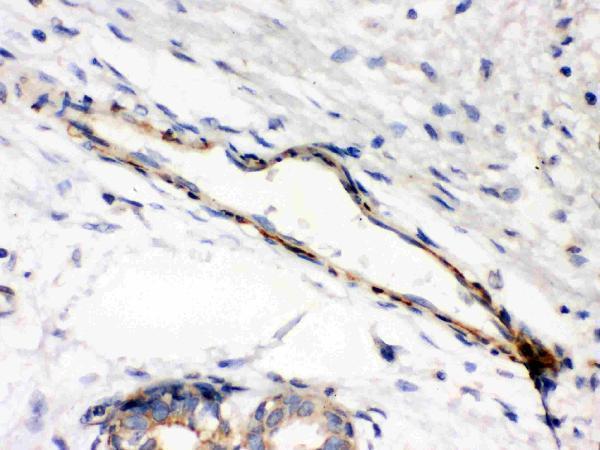 Anti-Caldesmon(smooth) antibody, MA1009, IHC(P)
IHC(P): Human Mammary Cancer Tissue