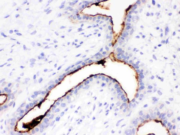 Anti-Episialin, EMA antibody, MA1039, IHC(P)
IHC(P): Human Mammary Cancer Tissue