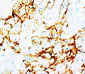 Anti-Tenascin antibody (monoclonal), MA1094, IHC(P)
IHC(P): Human Mammary Cancer Tissue