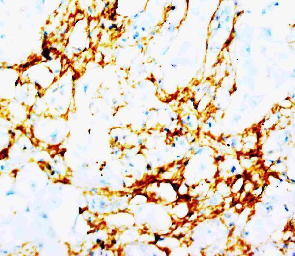 Anti-Tenascin antibody (monoclonal), MA1094, IHC(P)
IHC(P): Human Mammary Cancer Tissue