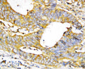 Anti-Caspase-1(P20) antibody, PA1440, IHC(P)
IHC(P): Human Mammary Cancer Tissue