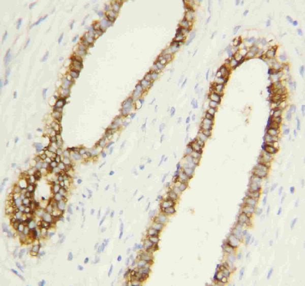 Anti-Caspase-1(P10) antibody, PA1522, IHC(P)
IHC(P): Human Mammary Cancer Tissue