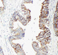 Anti-GST3/GST pi antibody, PA1590, IHC(P)
IHC(P): Human Intestinal Cancer Tissue