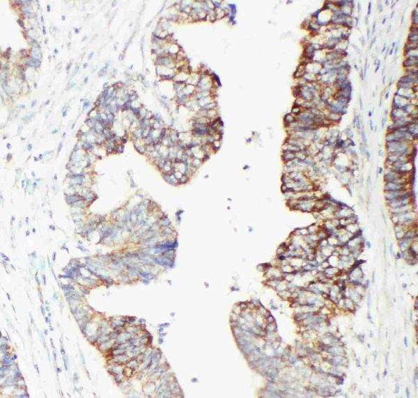 Anti-GST3/GST pi antibody, PA1590, IHC(P)
IHC(P): Human Intestinal Cancer Tissue