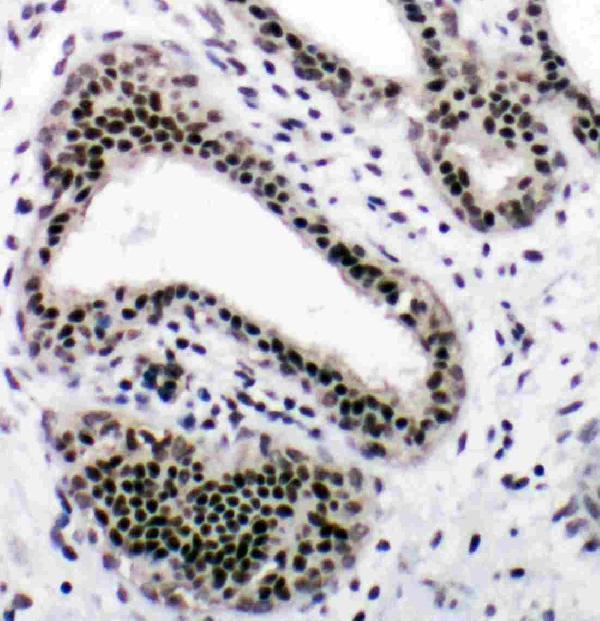 Anti-NRF1 antibody, PA1948, IHC(P)
IHC(P): Human Mammary Cancer Tissue