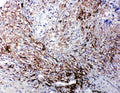 Anti-LTBR antibody, PA1968, IHC(P)
IHC(P): Human Intestinal Cancer Tissue