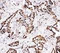 Anti-APLP1 antibody, PA2096, IHC(P)
IHC(P): Human Lung Cancer Tissue