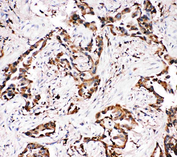 Anti-APLP1 antibody, PA2096, IHC(P)
IHC(P): Human Lung Cancer Tissue