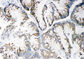 Anti-MMP14 antibody, PA2147, IHC(P)
IHC(P): Human Intestinal Cancer Tissue