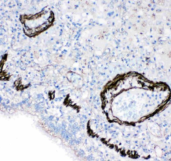 Anti-FABP6 antibody, PA2158, IHC(P)
IHC(P): Human Lung Cancer Tissue