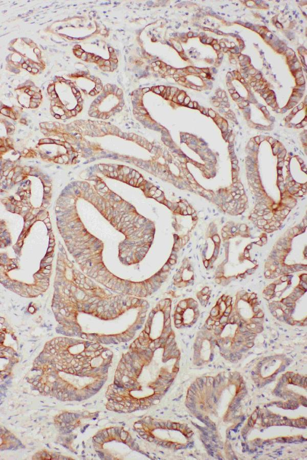 Anti-TNFAIP8L3 antibody, PA2257, IHC(P)
IHC(P): Human Intestinal Cancer Tissue