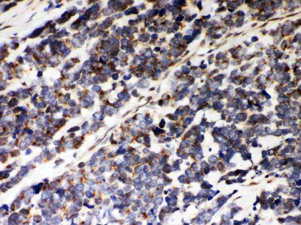 Anti-Peroxiredoxin 5 Picoband antibody, PB9384, IHC(P)
IHC(P): Human Lung Cancer Tissue