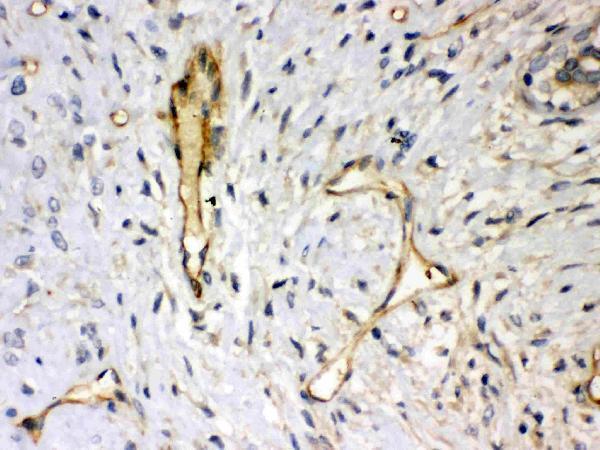 Anti-Syndecan 4 Picoband antibody, PB9388, IHC(P)
IHC(P): Human Mammary Cancer Tissue