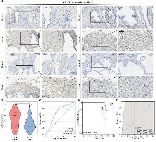 CCNA2 is highly expressed in PRAD and is associated with poor patient prognosis. (A, B) Differential expression of CCNA2 in PRAD. (C) Diagnostic predictive value of CCNA2 in PRAD. (D) KM curve of overall survival of CCNA2 in PRAD. (E) Prognostic predictive value of CCNA2 in PRAD.
Index in PubMed under a CC BY license. PMID: 38947325