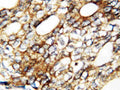 Anti-human FGF1 antibody, RP1005, IHC(P)
IHC(P): Human Mammary Cancer Tissue