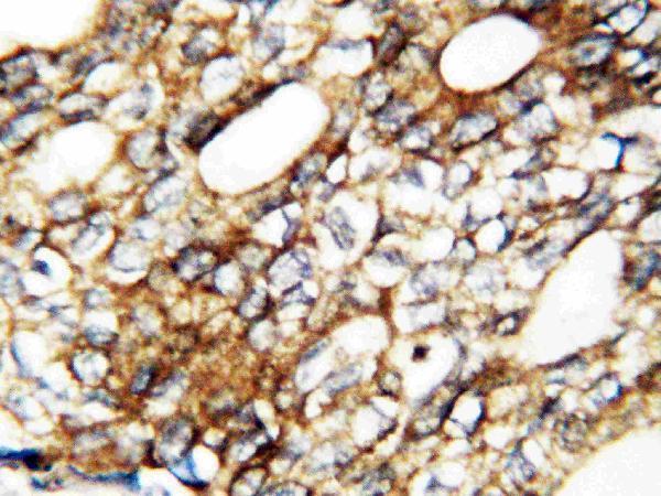 Anti-human FGF1 antibody, RP1005, IHC(P)
IHC(P): Human Mammary Cancer Tissue