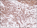 Diffuse strong estrogen receptor expression in mucinous breast carcinoma, anti-ER (DB 053), IHC.