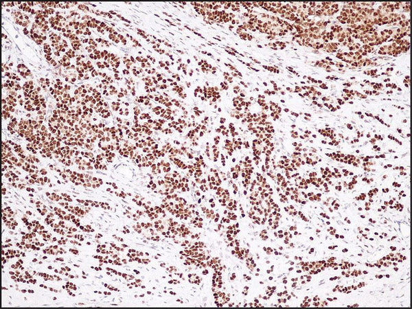 Diffuse strong estrogen receptor expression in mucinous breast carcinoma, anti-ER (DB 053), IHC.