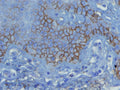 Early pemphigus vulgaris skin lesion with strong intraepidermal intercellular C3d staining, anti-C3d (DB 106), IHC.
